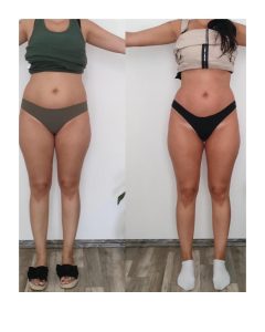 Lipolaser a dermomasáž je výbornou kombináciou v boji proti celulitíde