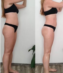 Lipolaser je revolúcia v tvarovaní postavy