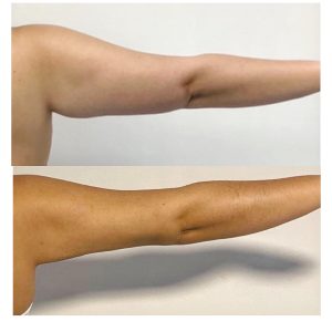 Lipolaser možno aplikovať aj na spodné ramená a lýtka